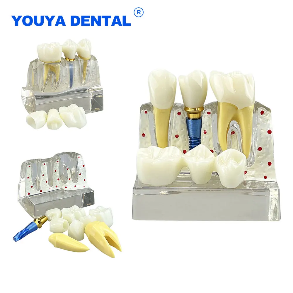 

Dental Implant Transparent 4 Times Teeth Model Removable Analysis Crown Bridge Model Teaching Study Dentistry Demonstration