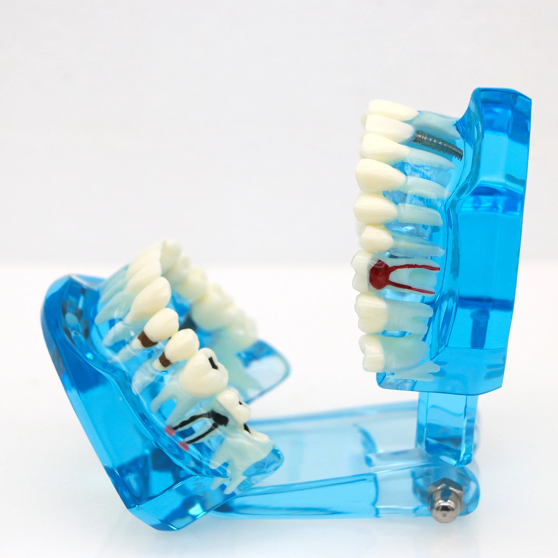 نموذج ترميم زرع الأسنان نموذج لتدريس طبيب الأسنان دراسة طب الأسنان منتجات طب الأسنان المعيار الأزرق 1:1 #4