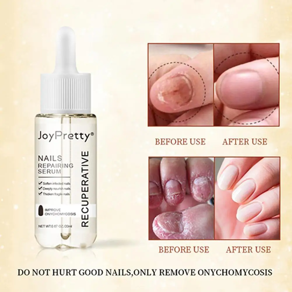 20ml Repairing Serum Nails Repairing Serum From Nourishing Nail Nails Serums 7 Day Protects Discoloration Toenail T5G4