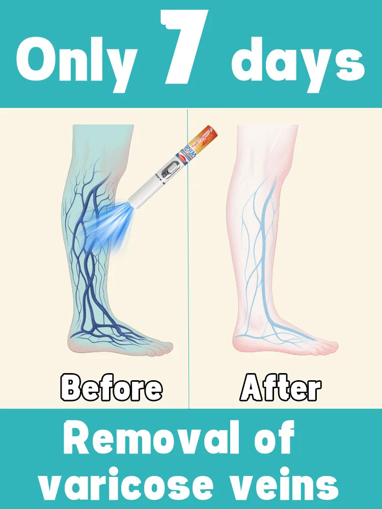

Say goodbye to varicose veins and spider legs in 7 days