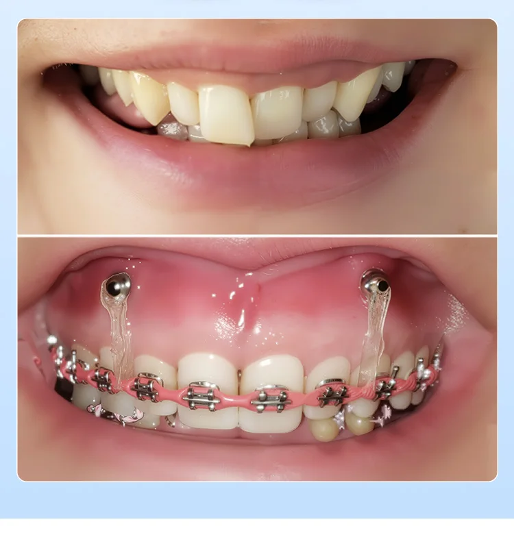AZDENT Dental Orthodontic Mini-Schraube Sterile Titanlegierung Selbstbohrende Gewindeschrauben Implantat-Mikroschrauben Zahnmedizin – Detail 15