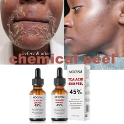 Peeling chemiczny Tca Peel Acid Peeling Acid 7-15 dni dostarczony Superforce Peeling pigmentacja skóry blizny potrądzikowe rozjaśniania skóry