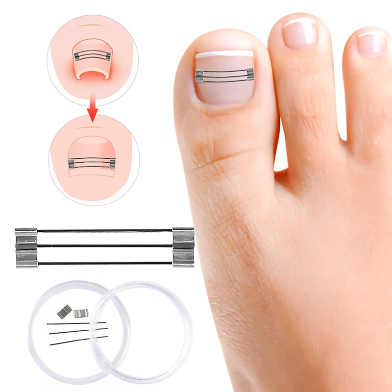 Corrector de uñas encarnadas, herramientas de sujeción, recuperación de pedicura, tratamiento de uñas encarnadas profesional, alisado de uñas encarnadas