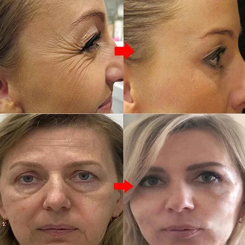 Collageen Eiwit Draad Instant Rimpel Remover Serum Set Lifting Verstevigende Oplosbare Absorbeerbare Gezicht Filler Anti-aging Huidverzorging