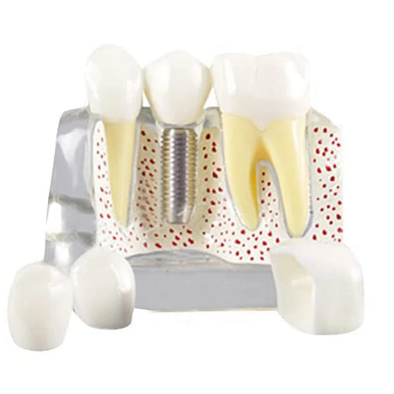 Teeth Demonstration Model Implant Removable Analysis Crown Bridge For -Patient Communication