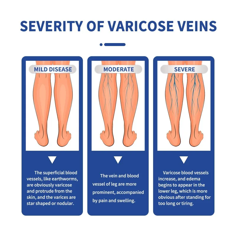 20g Venous Massage Varicose Cream Relieves Leg Vascular Protrusion Varicose Veins Earthworm Leg Repair Care Cream