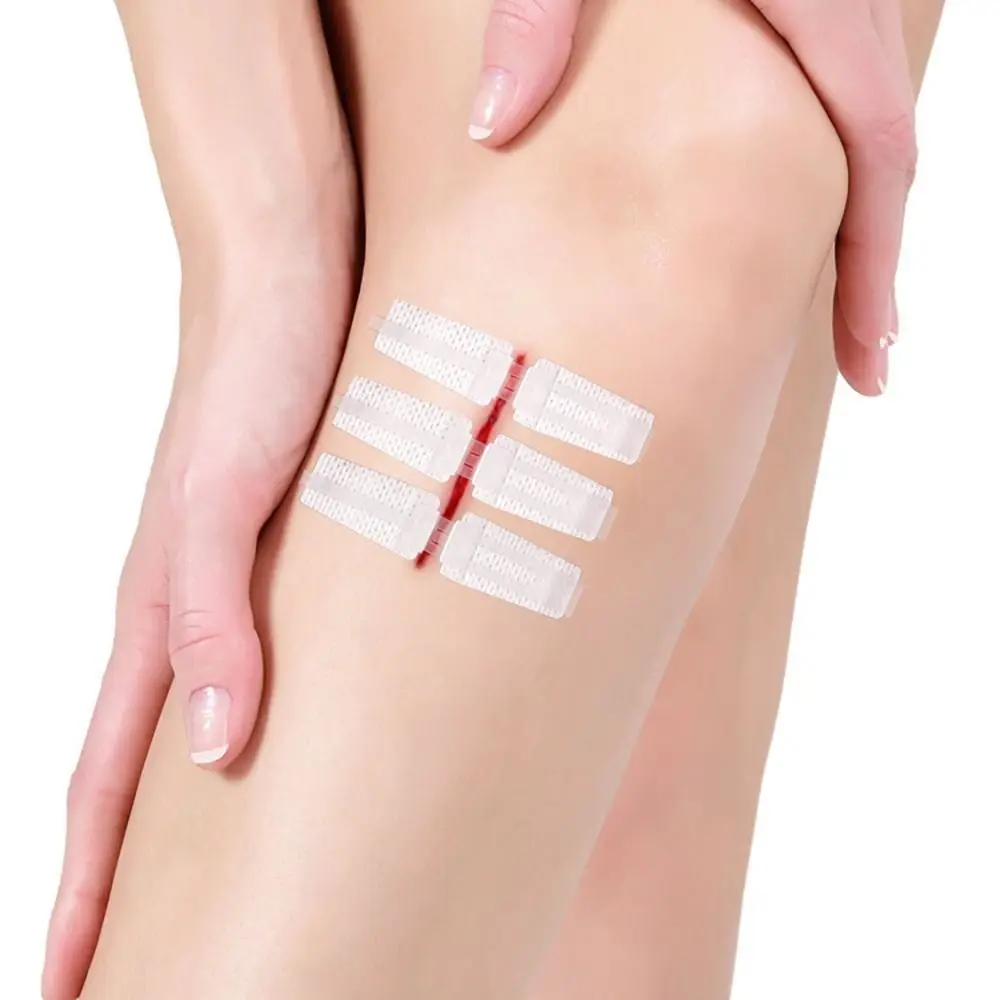 Adhesive Wound Care Zip Sutures Bandaids First Aid Without Stitches Zipper Laceration Repair Emergency Laceration Closures