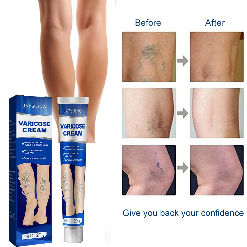 Varicose vein treatment cream relieves leg spider pain, vasculitis, phlebitis remover, vitamin K, swelling recovery