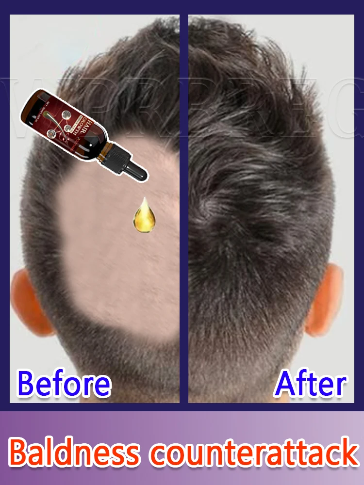 

Visible New Hairs in 7 Days Miracle Hair Growth Agent to Awaken Dormant Follicles