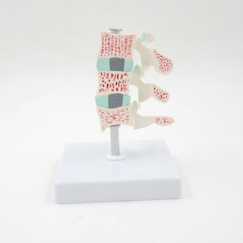 Osteoporosis disease model, spine and cervical dissection model, joint model