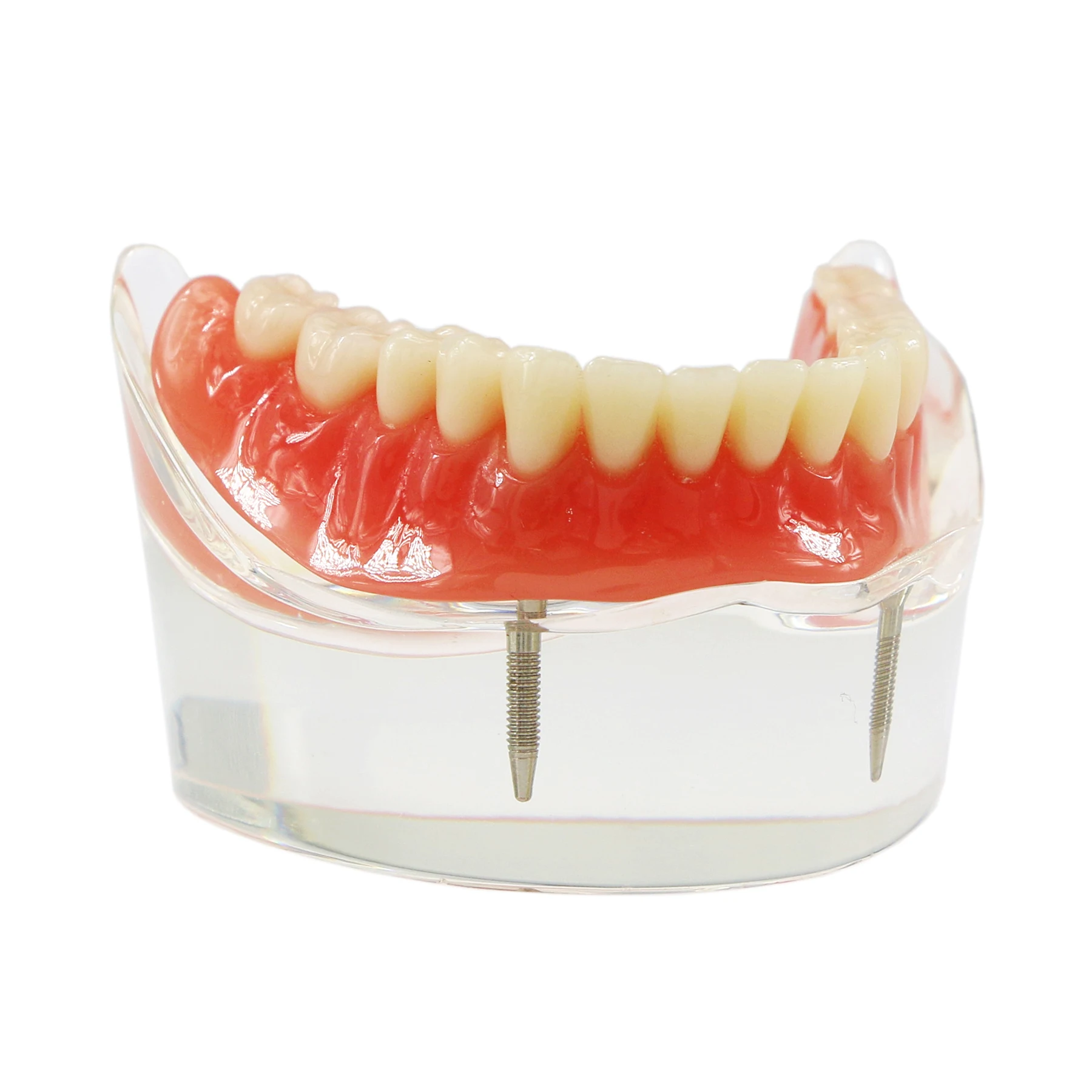 Dental Teeth Model M6002 Overdenture Inferior with 2 Implant Demo Lower Jaw Base