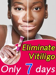 Vitiligo Treatment Cream Melanin Growth Ointment Fast Remove White Spot