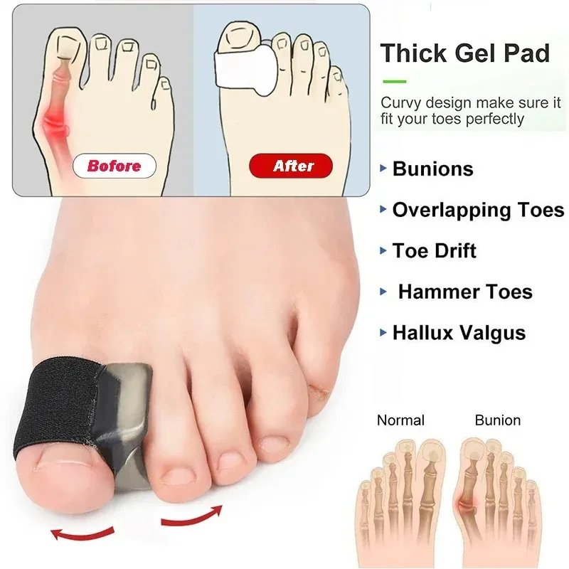 2pcs Bunion Corrector & Toe Separators, Medical Silicone Gel for Overlapping Toes, Hallux Valgus Pain Relief, Day & Night Wear