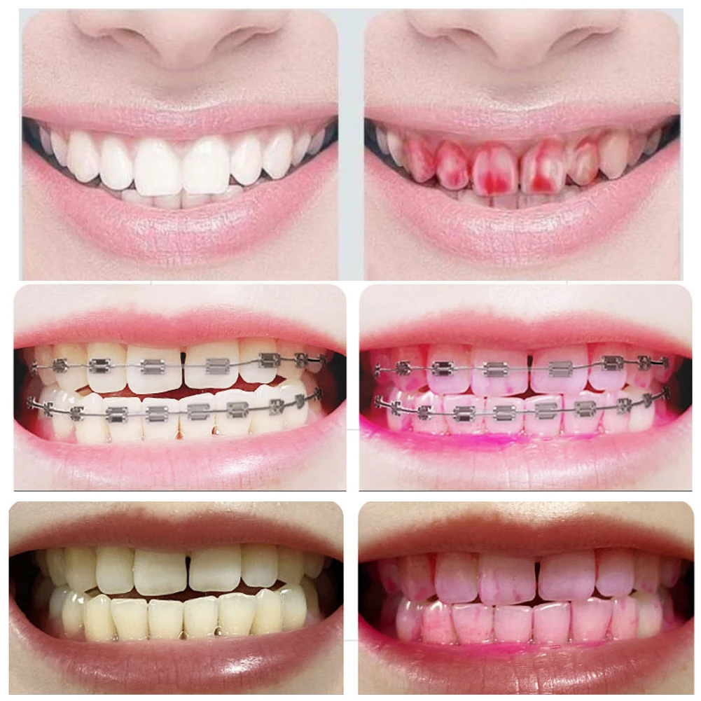 20Pcs Dental Plaque Indicate Cotton Swabs Children Adults Teeth Plaque Stain Checker Indicator Disclosing Solution Food Colorant