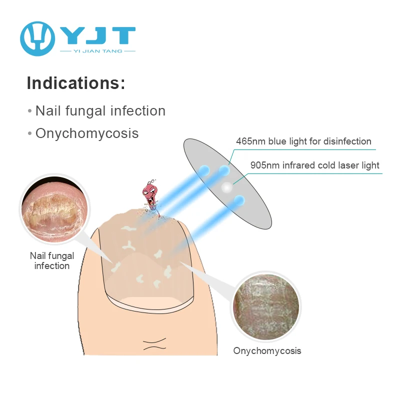 hnc fungus treatment laser device revolutionary ho blue light and red pain relief therapy relief apparatus