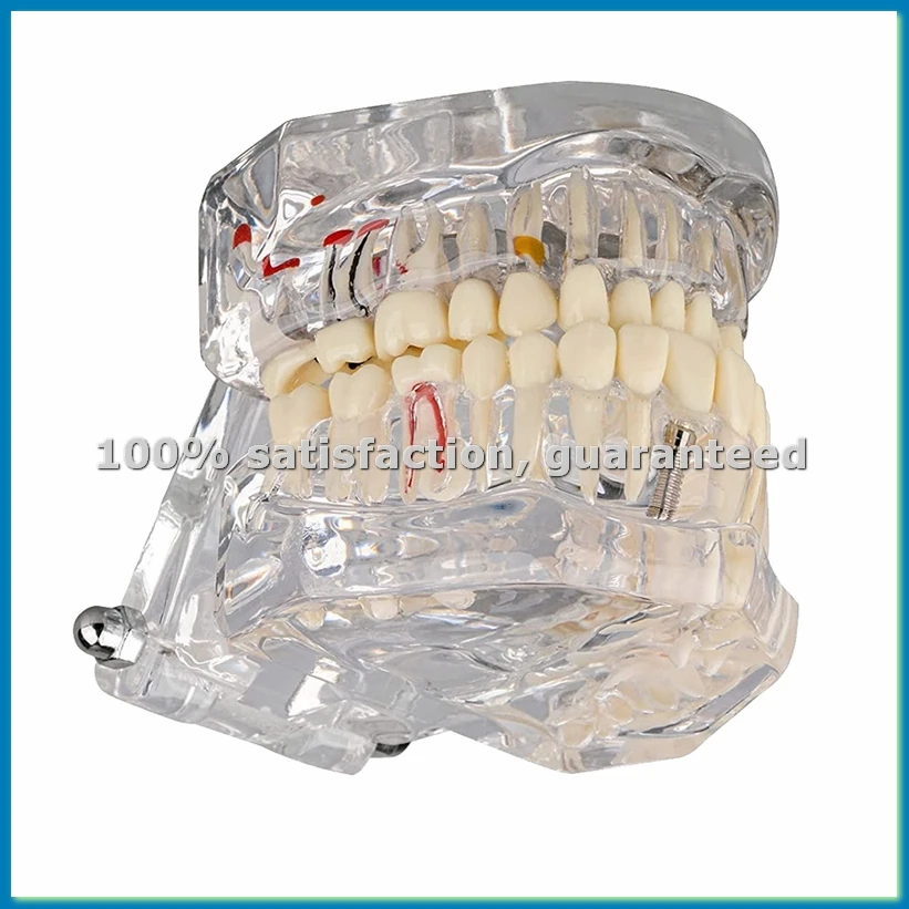 Transparent Disease Teeth Model with Dental Implant Bridge, Dental Model for Patient and Dental Student Education-ABLL