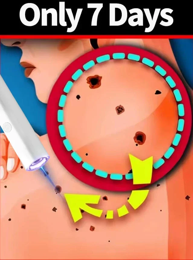 الضوء الأزرق، بالإضافة إلى تخفيضات أجزاء #1