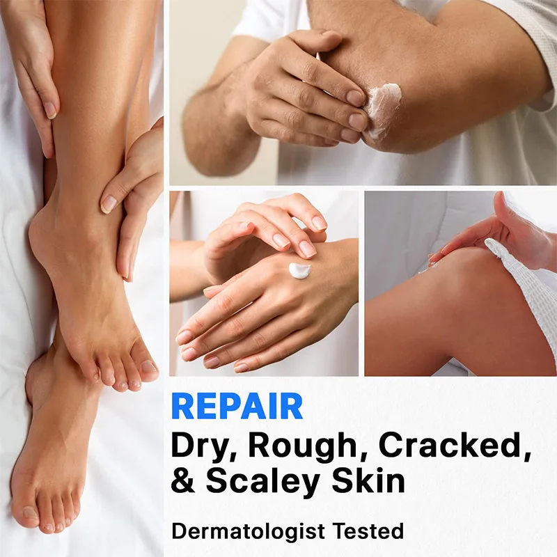 40% Urea Cream Hydrating Moisturizing Body Care Lotion Hand Foot Urea Cream