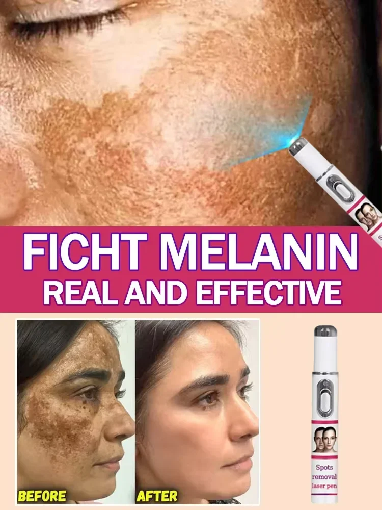 Freckles Melasma Melasma Dark Spots on Face Laser Pointer