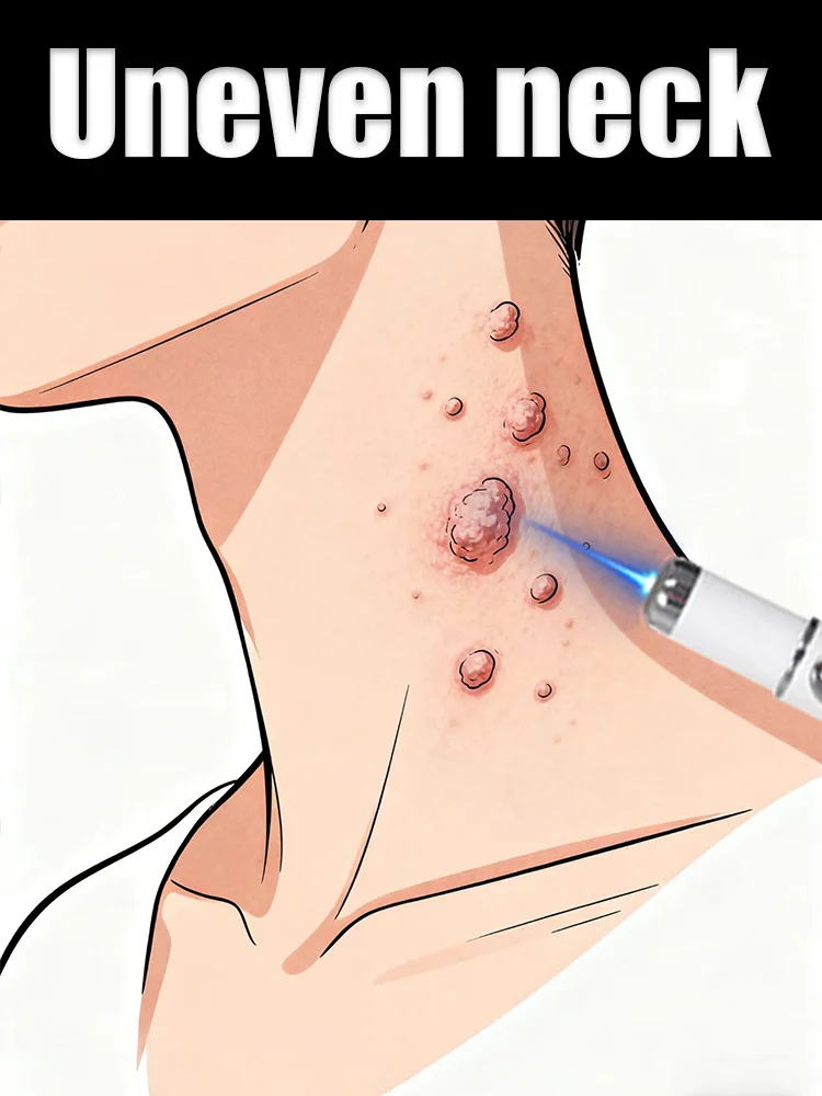 

Wart care tools for raised warts all over the body