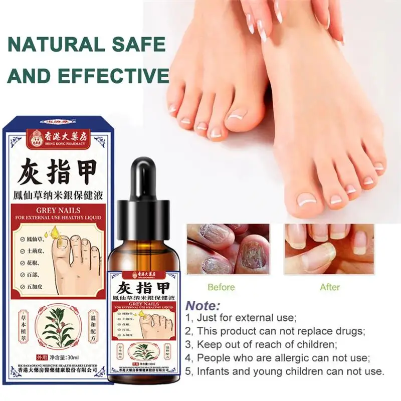Nail Fungus Treatment Serum Foot Repair Liquid Toe Nails Fungal Removal Gel Anti Infection Paronychia Onychomycosis Cream 30ml