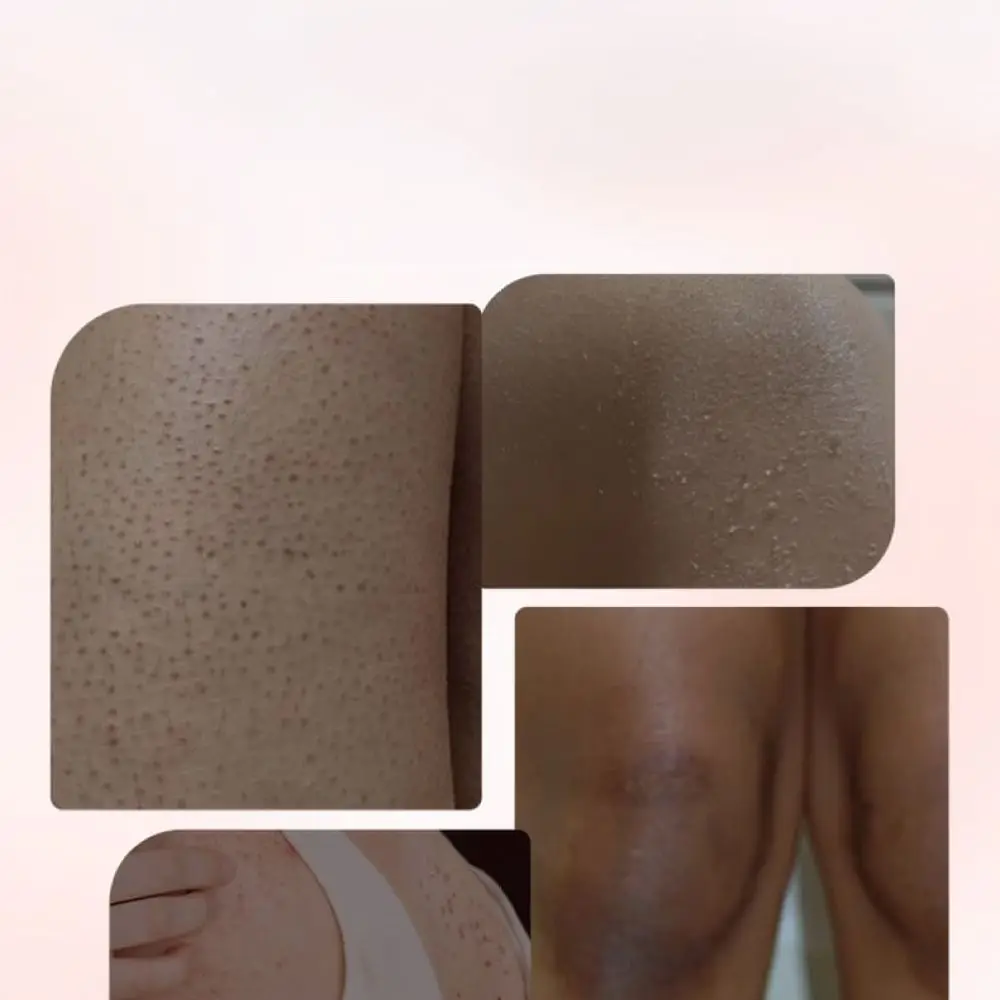 For Qise Body Scrub Exfoliating Treatment Pomegranate Arbutin Extract Deep Cleansing Hydrating Smoothing Skin Texture