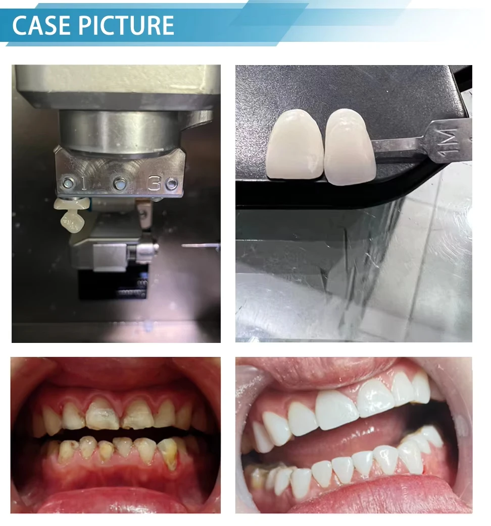 Рисунок 5 - Стоматологические стеклянные керамические