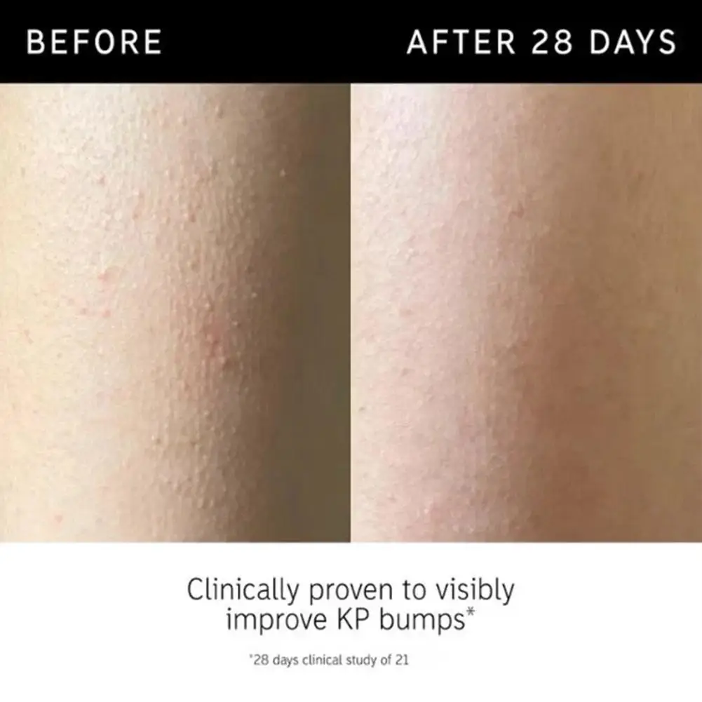 Glykolsäure-Peeling-Stick von The INKEY List, Körperglättender Peeling-Stick für Keratosis Pilaris und ungleichmäßige Hautstruktur – Detail 13