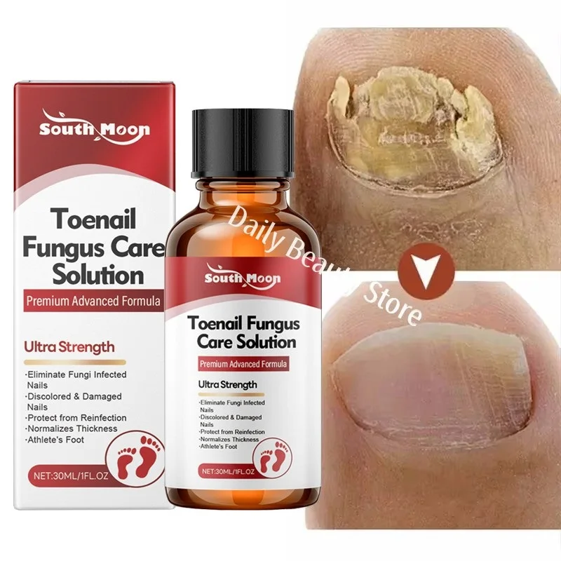 

Сыворотка для лечения грибка ногтей, средство для удаления грибка ногтей, жидкость для паронихии, антисерые ногти, инфекция пальцев, инструменты для ухода за ногами