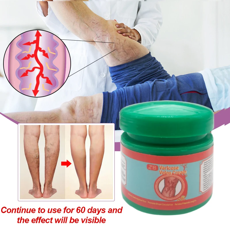 20g Varicose Veins Relief Ointment Effective Relieve Vasculitis Phlebitis Spider Pain Treat Cream Improves Circulation Body Care