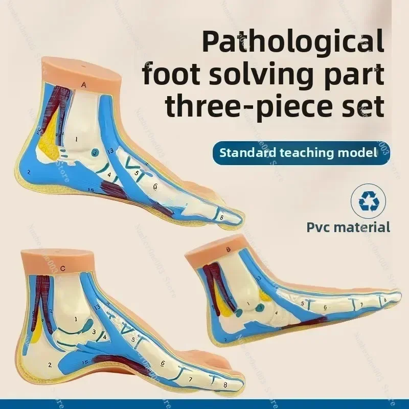 Foot Anatomy Model Normal and Flat Arch Foot Structure Muscles and Vessels Medical Teaching Model