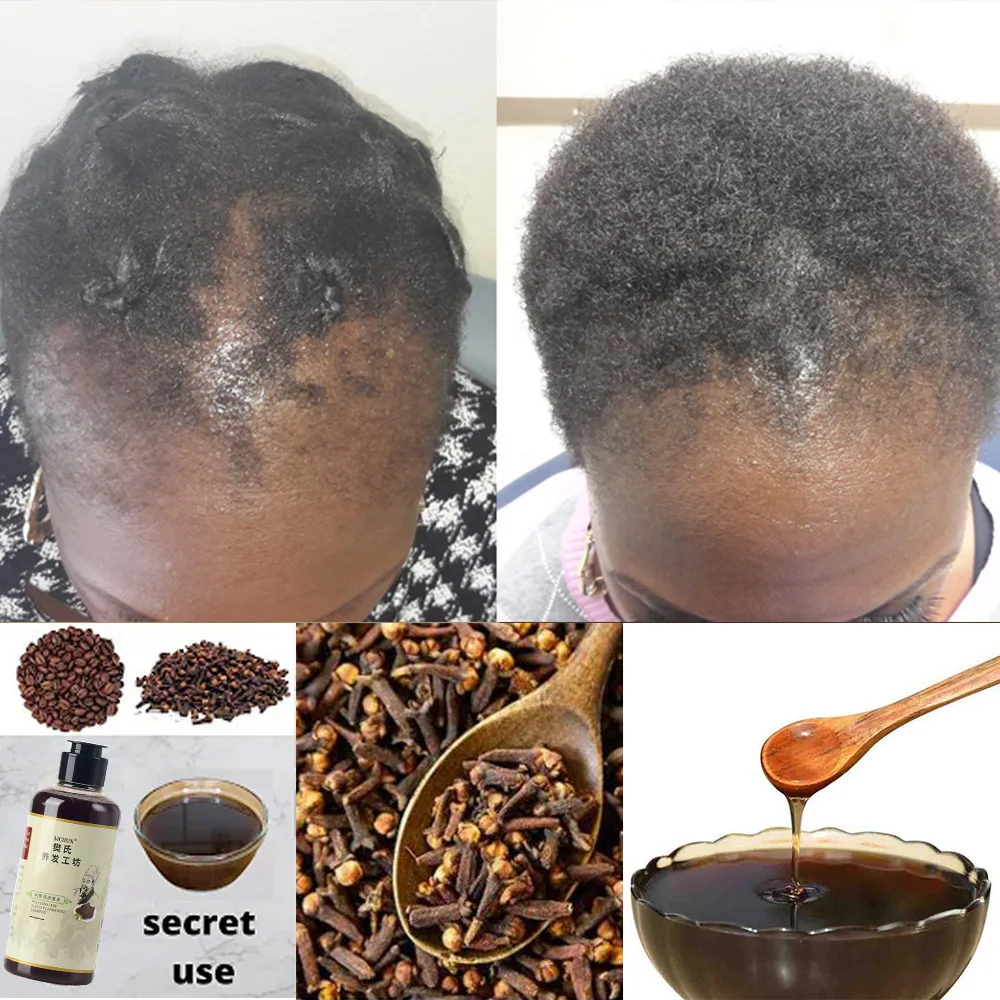 300ml Africa Women Traction Alopecia Treatment Hair Growth Product for Men Shampoo Hair Loss Treatment Get Rid of Wigs 2pcs/lot