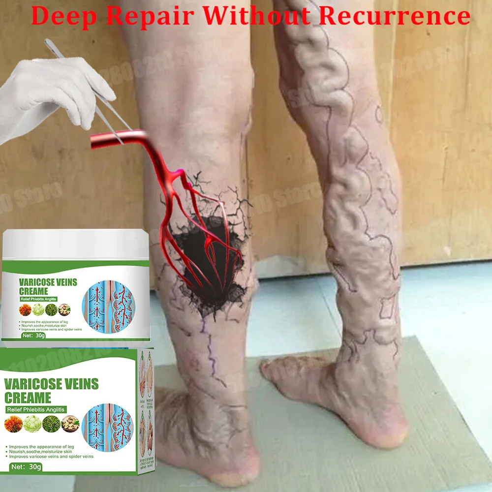 Varicose vein ointment, red blood streak repair agent, promotes venous blood circulation, repairs varicose veins