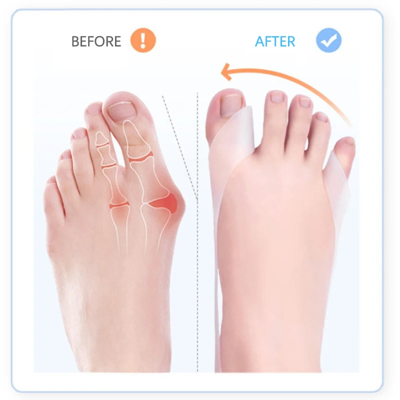 Corrector ortopédico de férula para Hallux Valgus, separador de dedos, herramienta para el cuidado de los pies, alivio del dolor, pedicura, 1 par