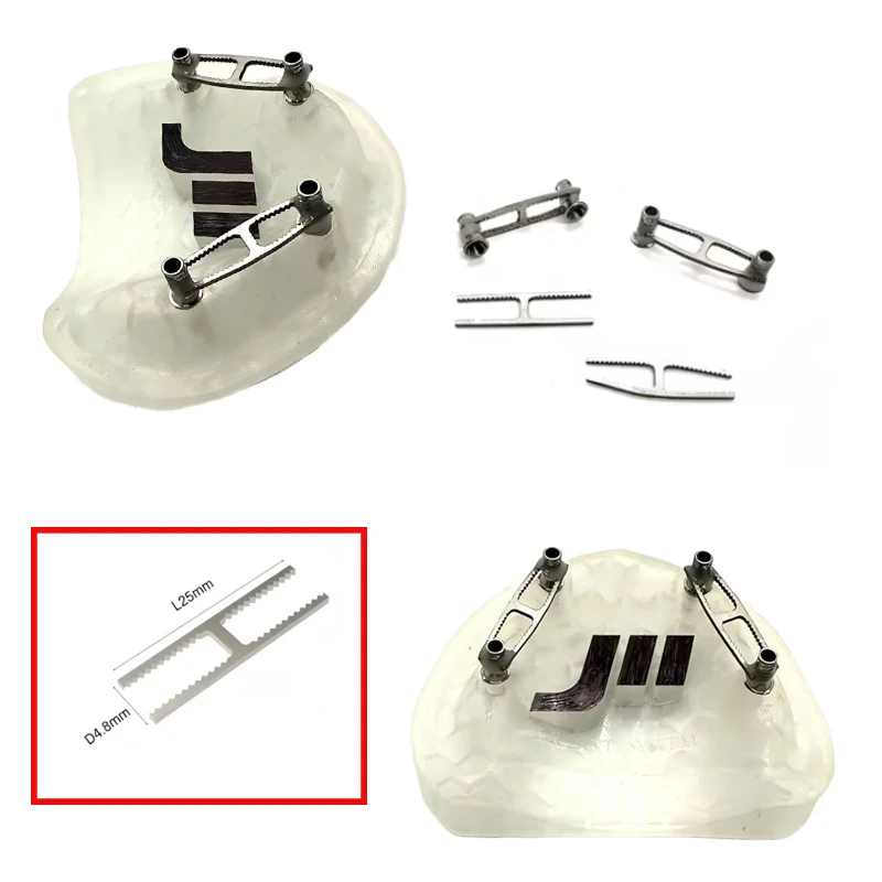 10 Pcs/Bag Implant Impression Reinforcing Bar, Dental Lab, Fits Straumann & Nobel, Temp Bridge & Multi-Implant Analog Connection