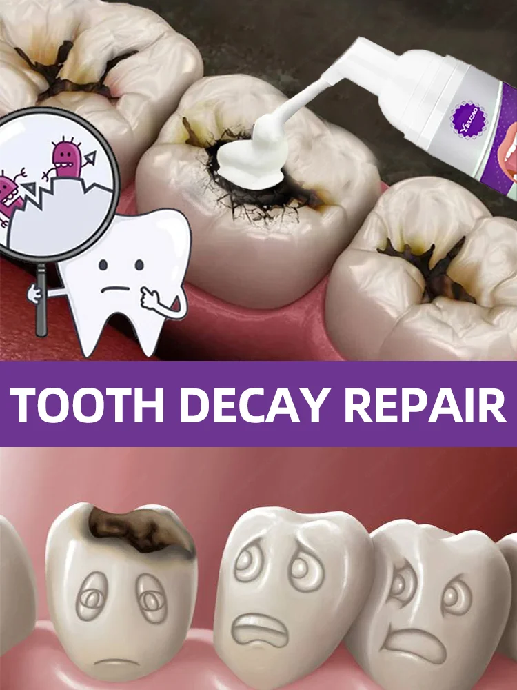 Repair Decay Cavities Anti Caries