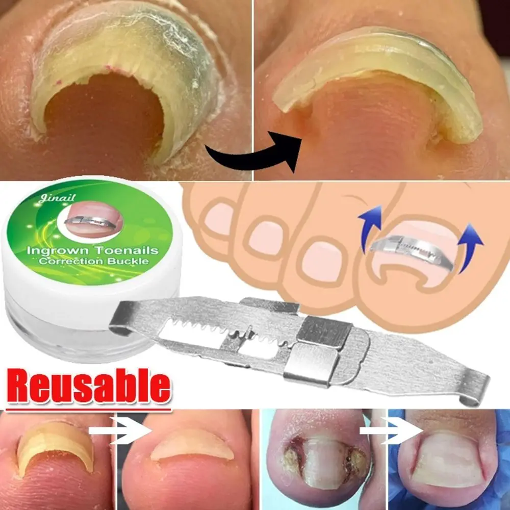 Effective Foot Health Care Paronychia Ingrown Toenail Straightener Pedicure Tools Correction