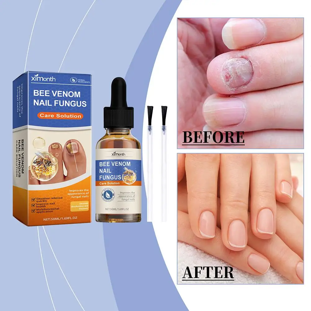 50ml Bee Venom Nail Care Liqud Inhibits Fungal Nail Polish Suitable For Nail Care Among Nail Patients Nail Care Products O8l1