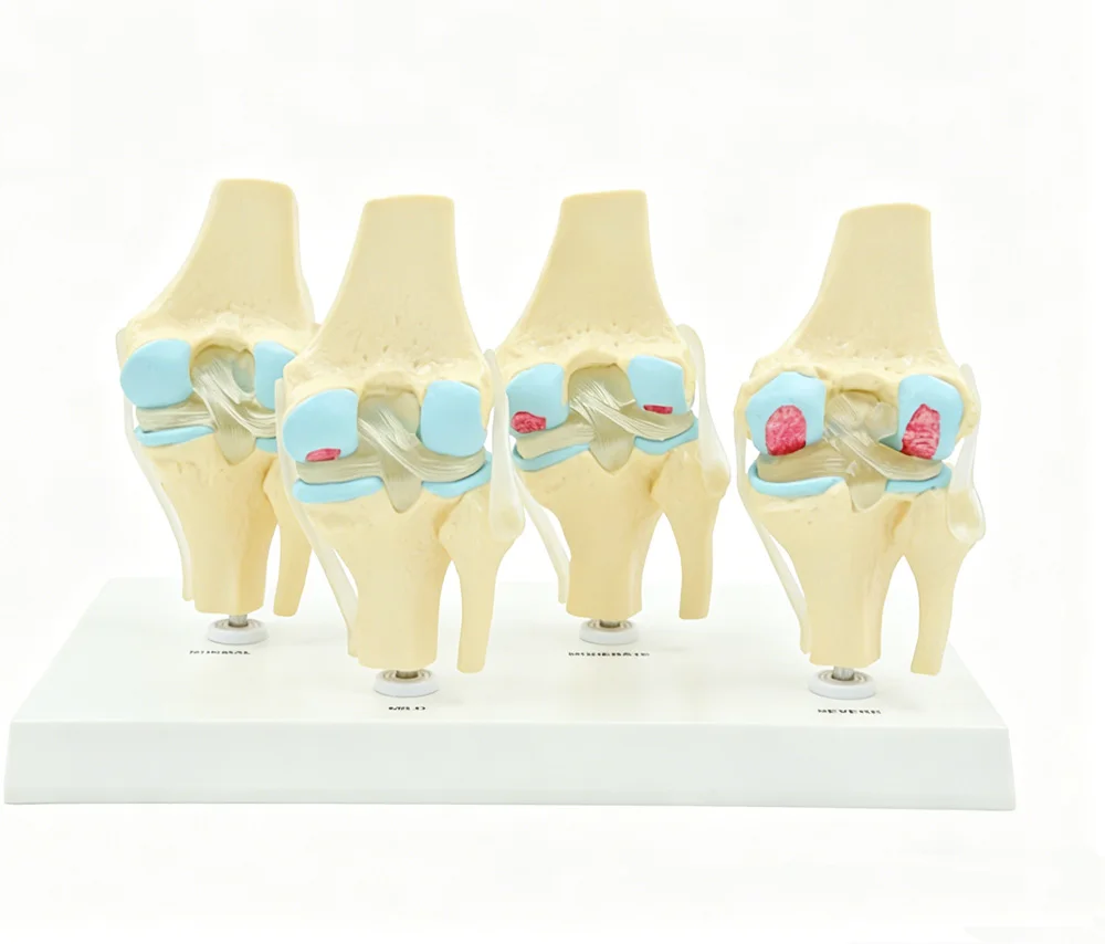 解剖学的人体四段階膝関節モデル変性膝関節疾患モデル医療用骨格解剖学pvc