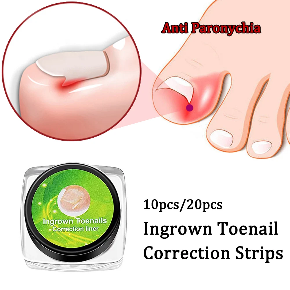 10pcs Ingrown Toenail Correction Strips Anti Paronychia Correction Straightening Toe Nail Treatment Groove Pedicure Pain Relief