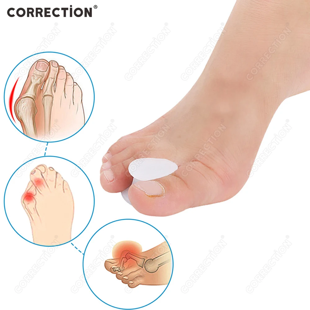 תיקון סיליקון הבהונות מפריד פיקה עצם Ectropion שמאי מכשיר חיצוני רגל טיפול כלים מתקן