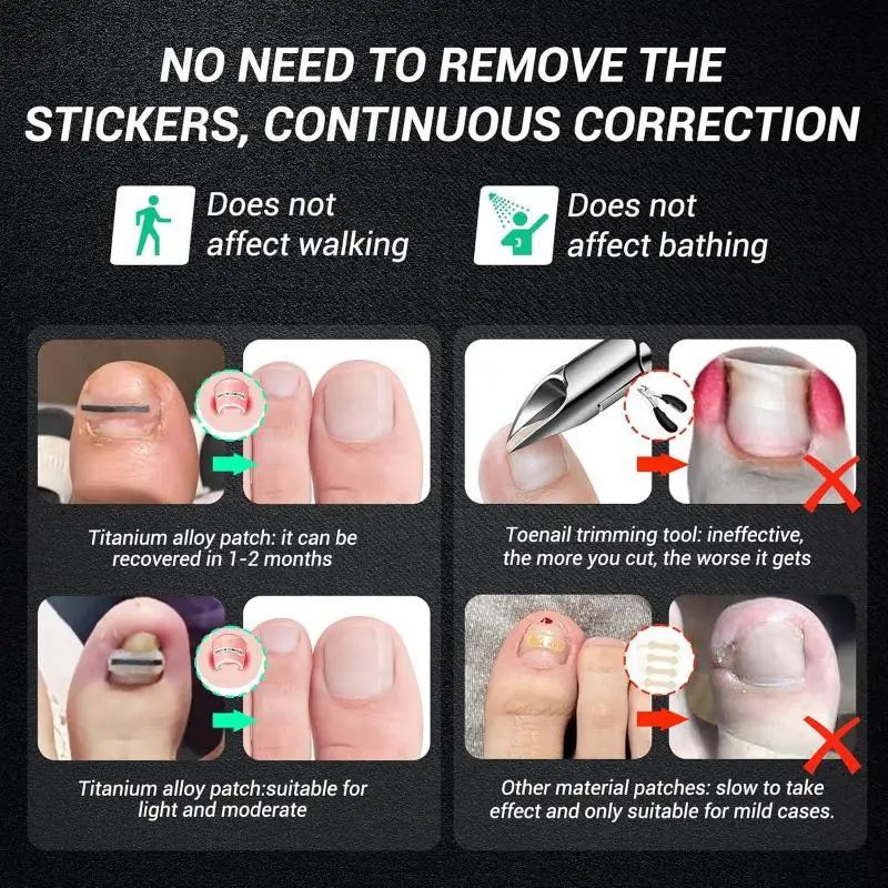 5 個陥入爪矯正ツール陥入爪治療弾性パッチステッカー矯正クリップブレースペディキュアツール