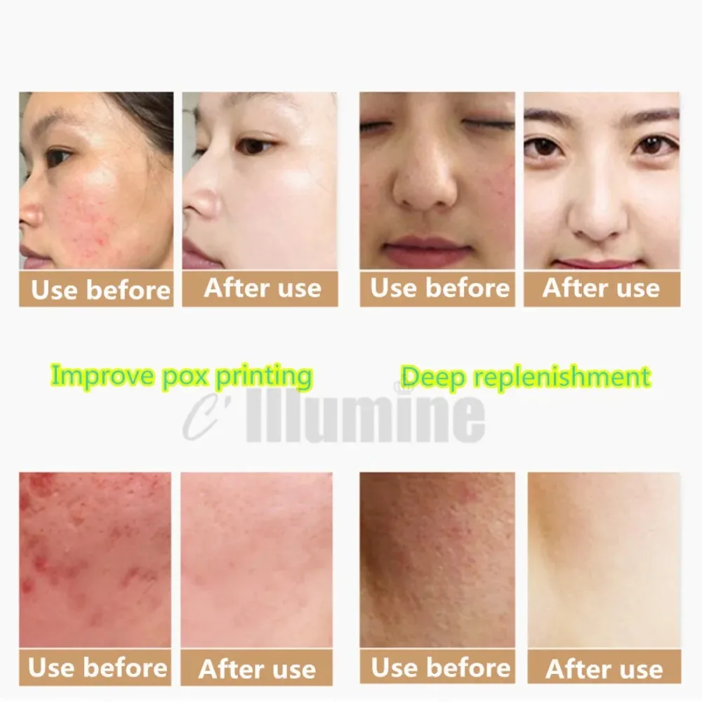 Pure Snail Slime Mucus Same As Snail Crawling On The Face Treatment Beauty Salon Equipment