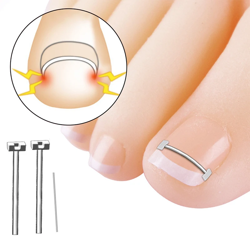 Corrector de uñas encarnadas para el cuidado de los pies, herramienta profesional de pedicura, tratamiento de uñas encarnadas, 10 piezas