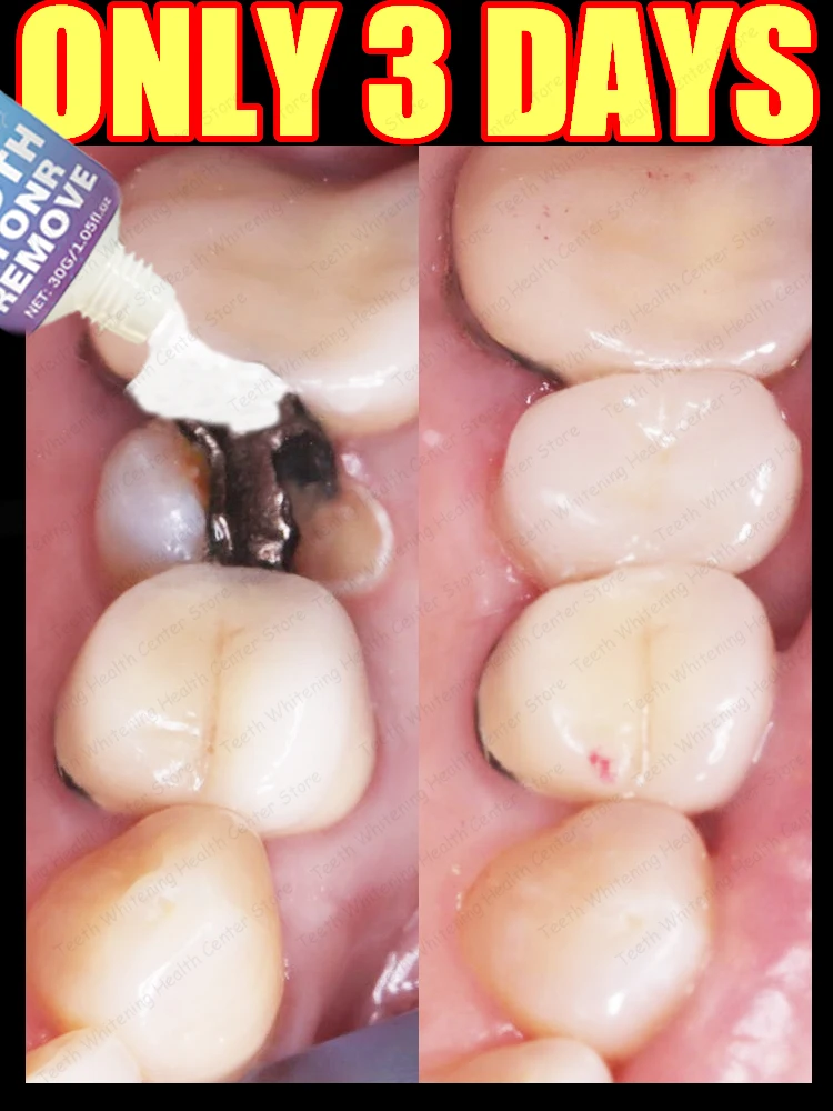 

Разбить вас более уверенно, удаляет карниз и защищает ваши зубы, хит продаж.