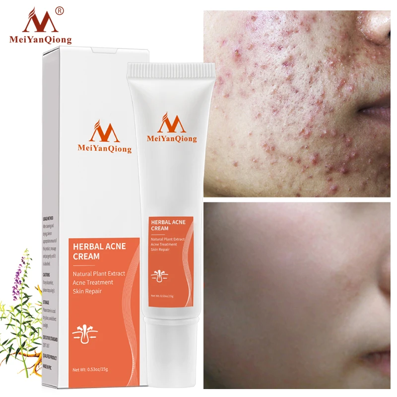 Acne Cream Acne Removal Eliminate Acne Marks Repair Damaged Skin Moisturizing Nourishing Whitening Skin Rejuvenating Face Care