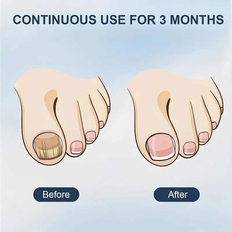 Dispositif lumineux pour champignons des ongles, 1/2/4 pièces, pour ongles des pieds et des mains