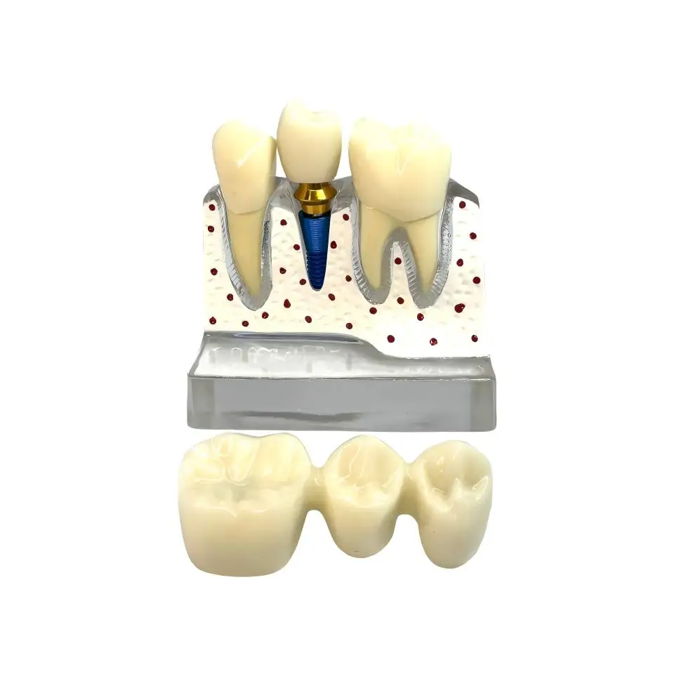 Dental Implant Pathology Demonstration Model Transparent Base Detachable Crown Bridge Abutment for Patient EducationConsultation