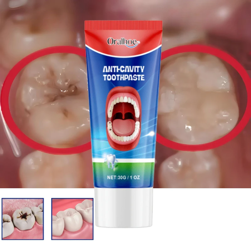 New Tooth Decay Prevention Toothpaste Effective Treatment Decayed Tooth Whitening Toothpaste Removal Yellow Toothpaste TeethCare