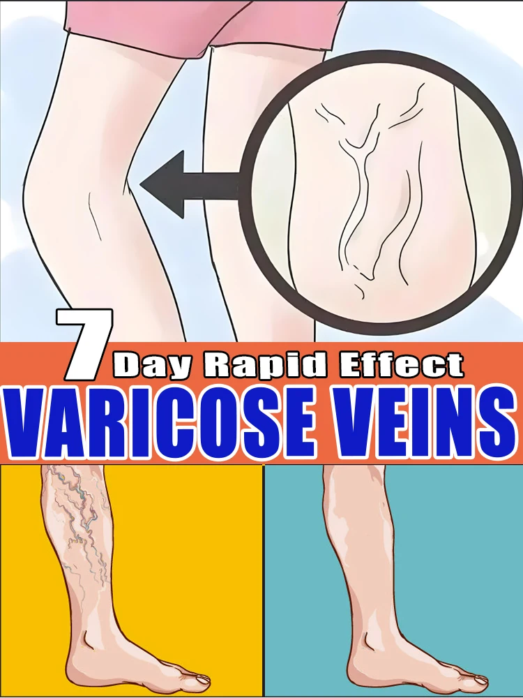 

Varicose Vein Lampshade Therapy Effective Relief Of Dilated Vasculitis In The Legs Phlebitis Improved Blood Circulation New